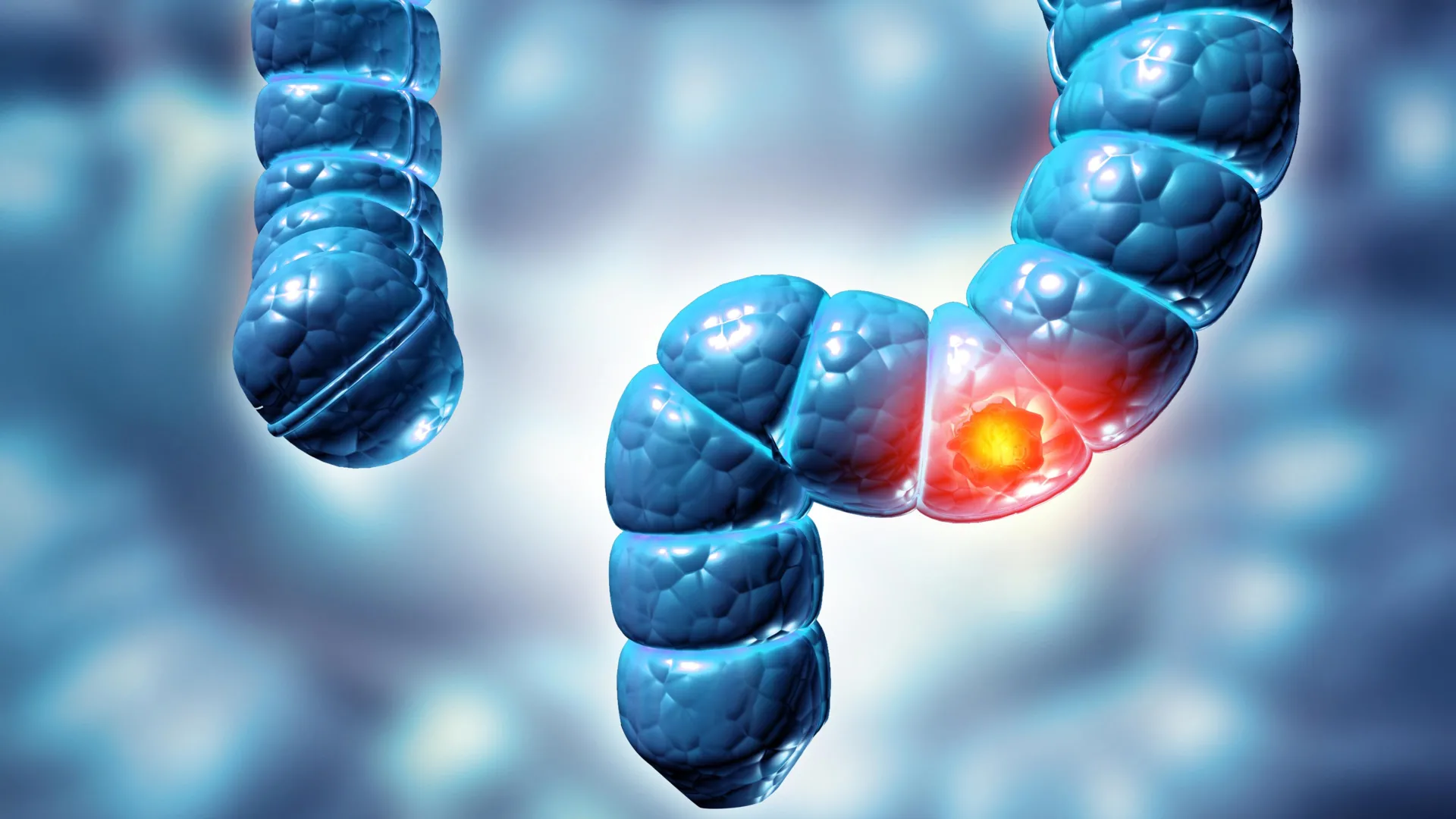 Colorectal cancer is rising in young people and often found too late
