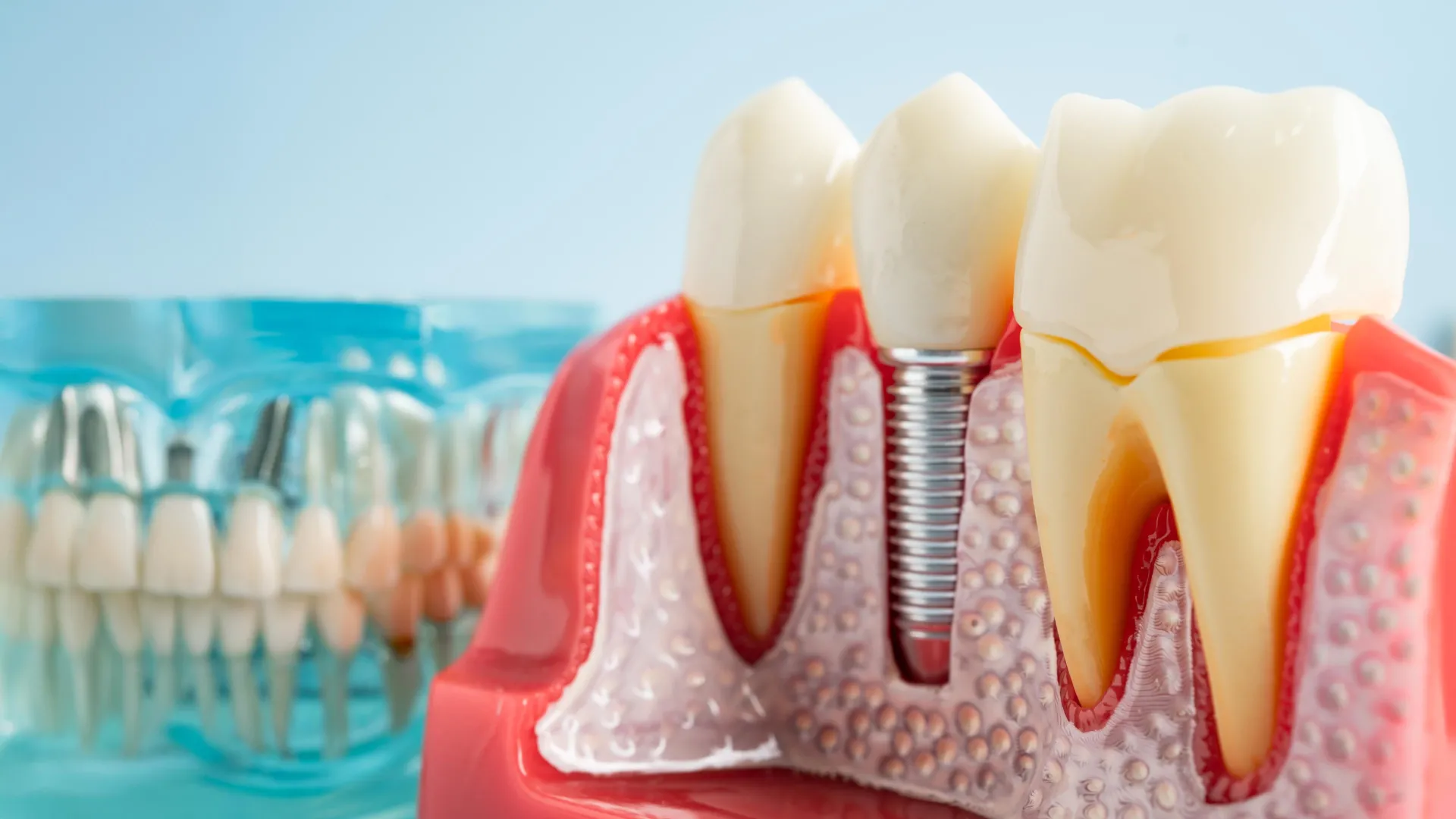 Dental implants can hijack your immune system, scientists discover
