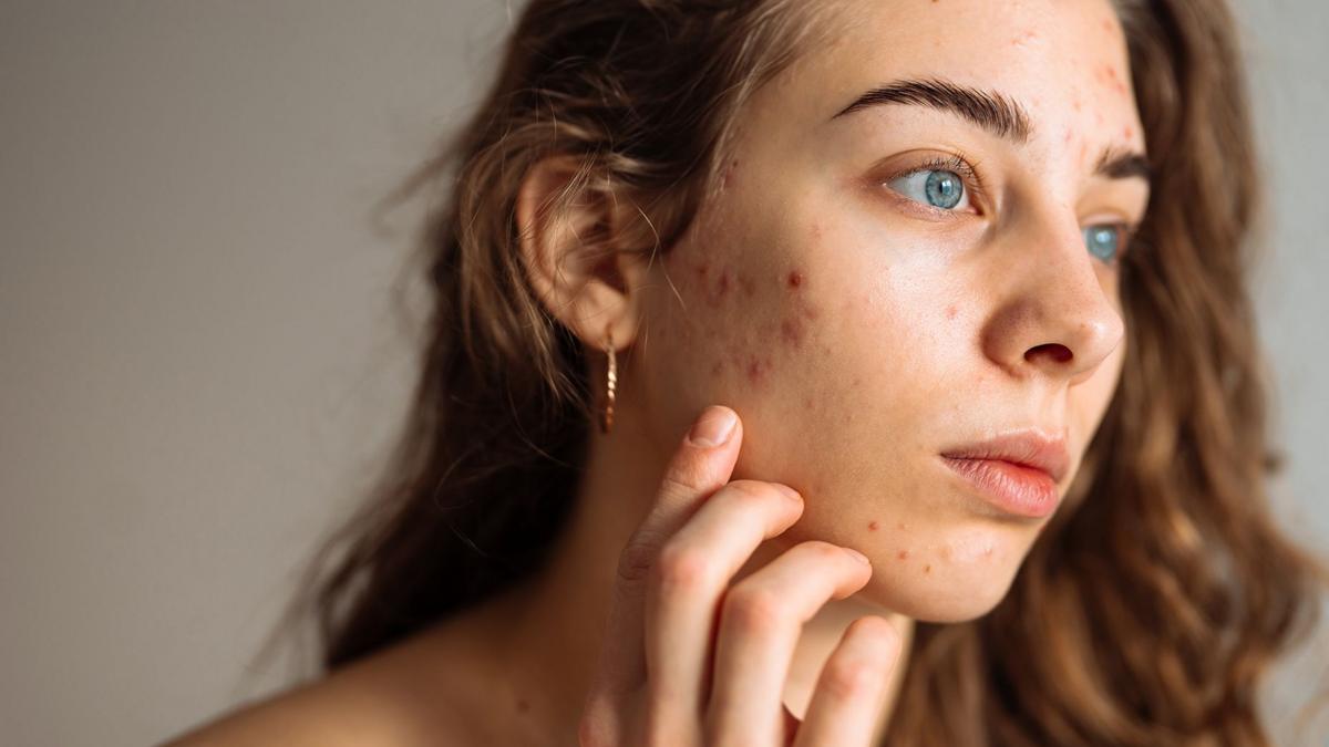 5 consejos de expertos para cuidar la piel adolescente y evitar rutinas que pueden afectarla