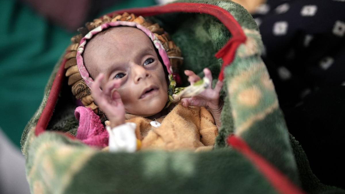 "Solo piel y huesos": los gemelos recién nacidos que tratan de sobrevivir a la guerra y el hambre en Yemen