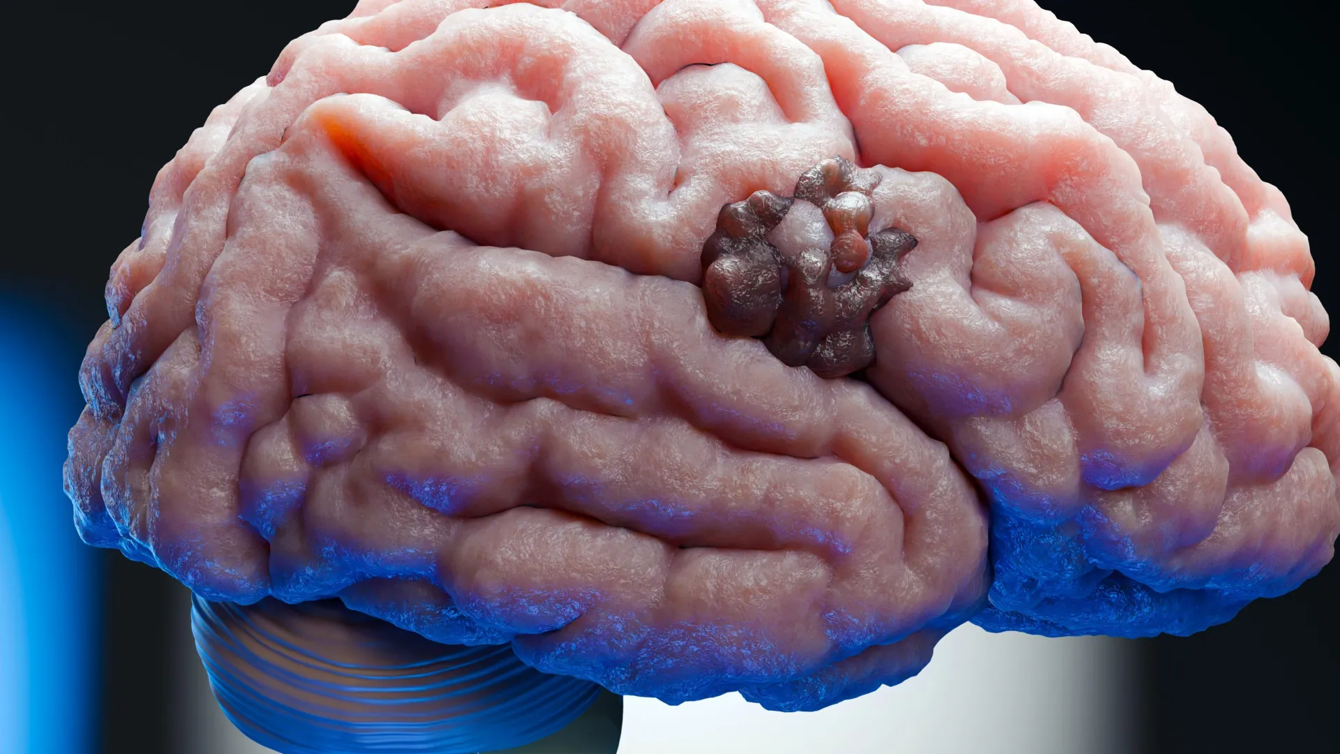 Scientists find a weak spot in one of the deadliest brain cancers