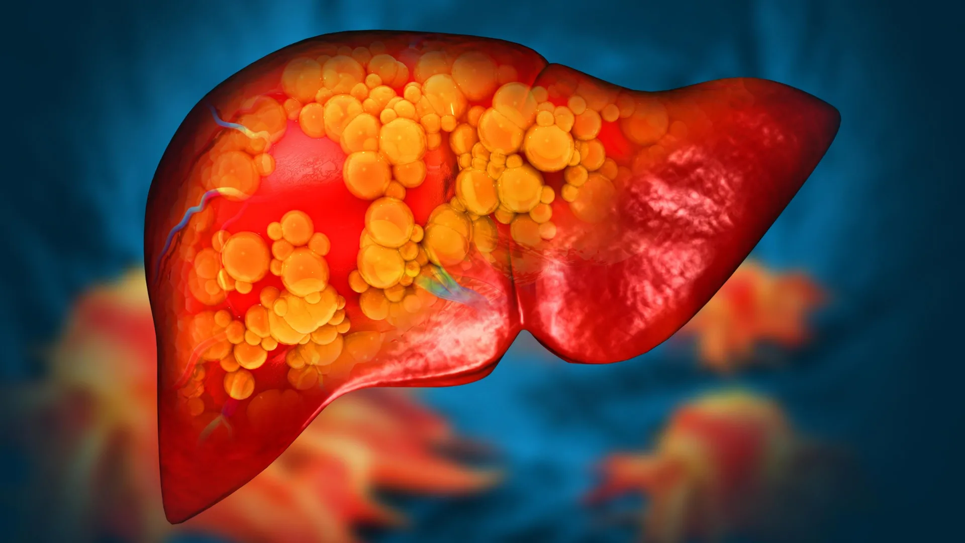 A plastic once thought harmless may be fueling fatty liver disease