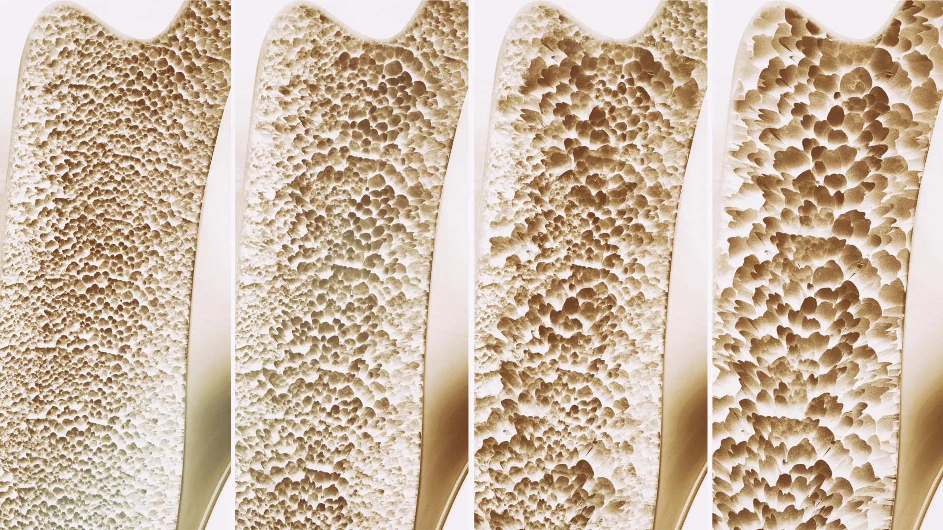 Scientists find a bone-building switch that could fight osteoporosis