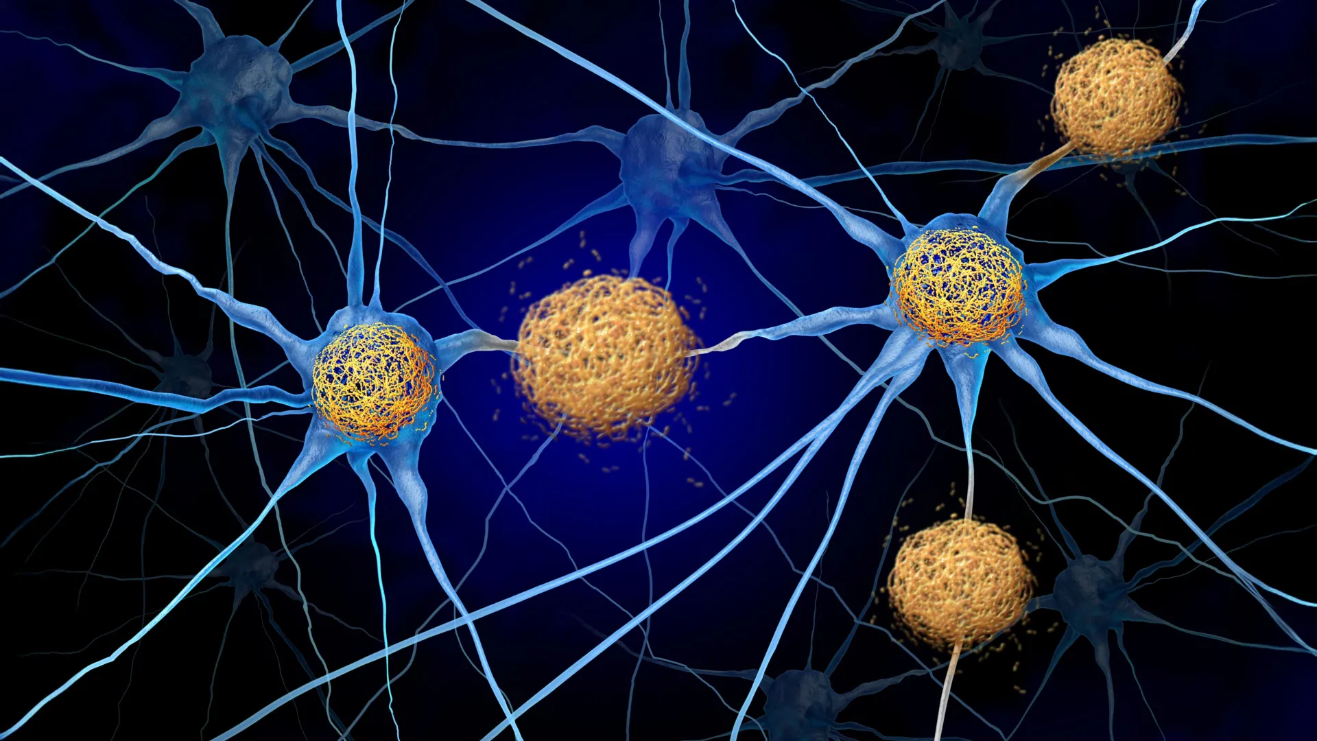 Scientists may have overlooked a hidden Alzheimer's culprit for decades